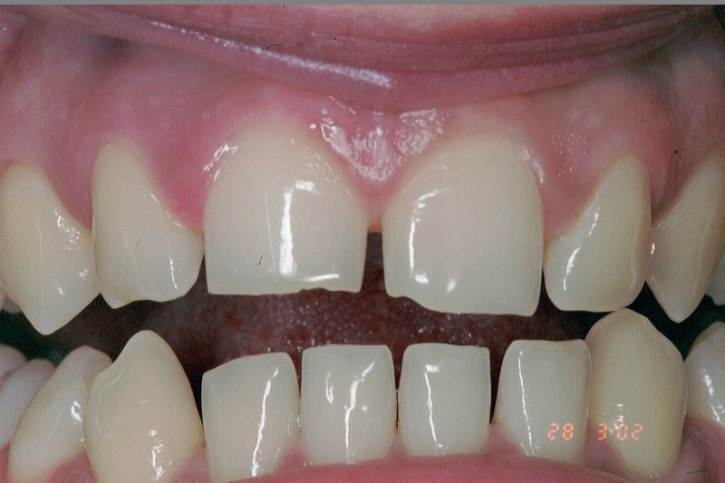 HP_Veneers