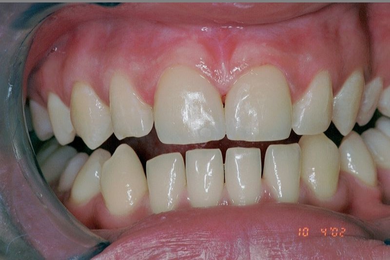 HP_Veneers